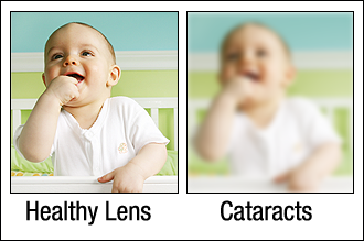 Cataract Example