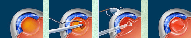 Cataract Surgery Diagram