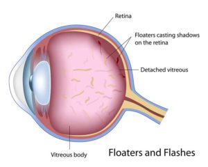 Eye Floaters Example