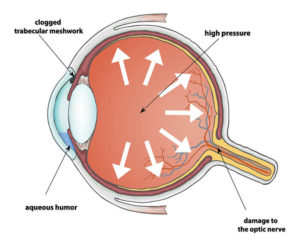 Glaucoma Chart