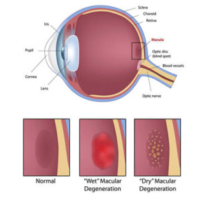 Macular Degeneration Chart