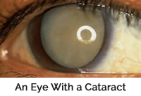 Mature Cataract in eyeball